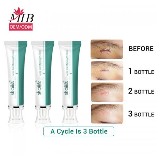 Acne Scar Removal Cream